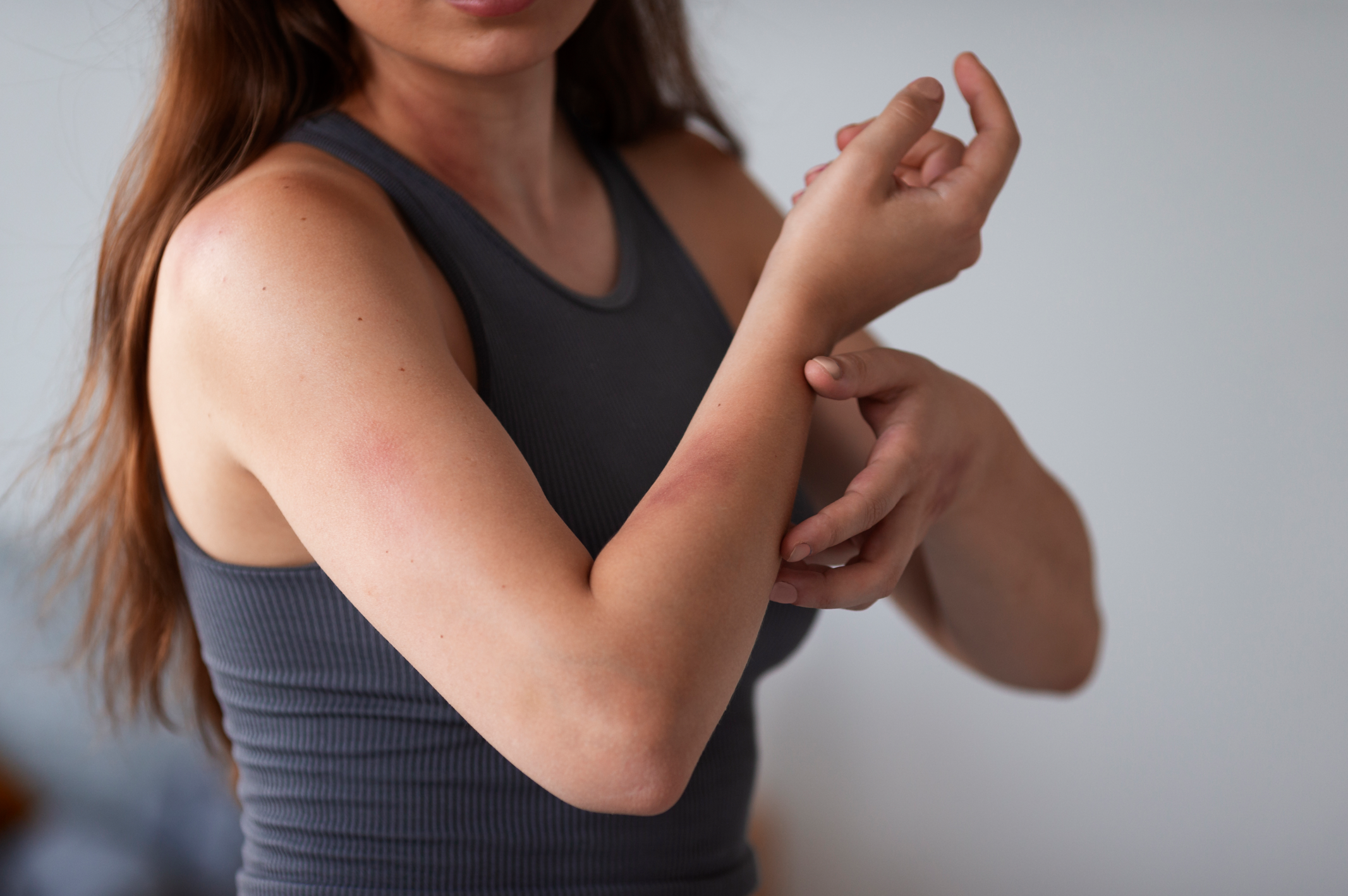 Autolesiones ilustradas con un brazo femenino con hematomas